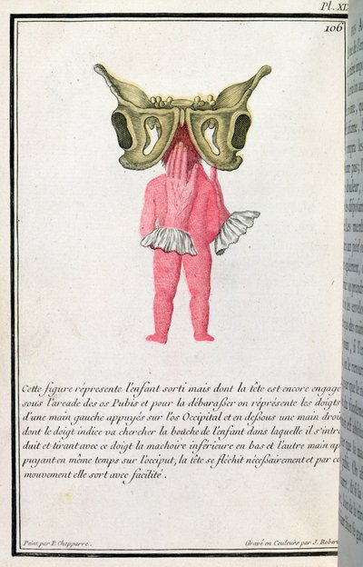 Cross-Sectional Diagram of a Baby Pulled from the Womb, from a Book by Madame Angelique Le Boursier du Coudray, engraved by J. Robert, 1783 by P. Chapparre